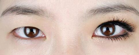 唐山紫水仙韩式双眼皮手术