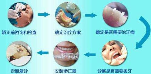 东港市口腔医院牙齿矫正流程