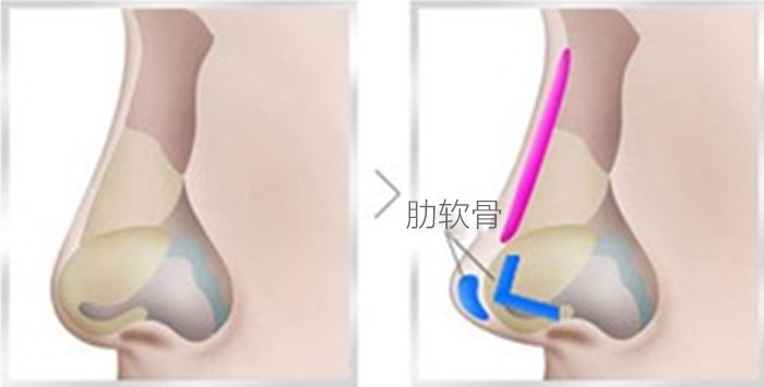 南宁陈炳俊医疗美容自体软骨隆鼻