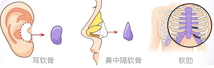 南宁陈炳俊医疗美容自体软骨隆鼻