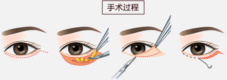 宁波时光美极祛眼袋手术