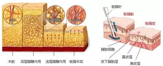 沈阳名流韩式分层吸脂