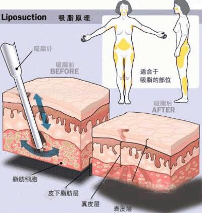 韩国维摩腰腹吸脂手术原理