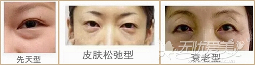 苏州圣爱韩式隐形祛眼袋适应症