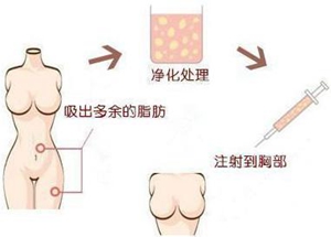 西宁韩亚整形自体脂肪隆胸手术