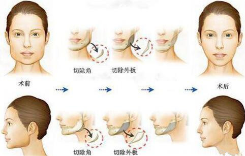 韩国JK下颌角整形手术