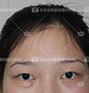北京京民郭建玲主任全切双眼皮整形案例,解决了我的肿眼泡!