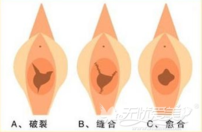 福州台江处女膜修复手术效果