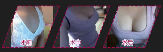 广州凯美达自体脂肪隆胸手术效果图