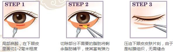 内蒙古永泰内路法祛眼袋手术