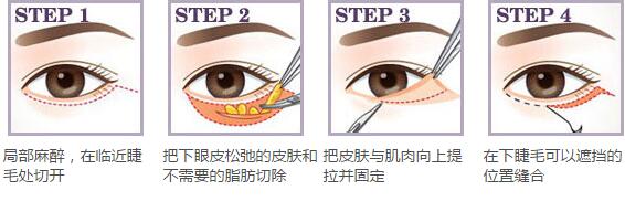 内蒙古永泰外路法祛眼袋手术