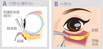 珠海艾贝尔祛眼袋手术