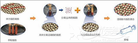 哈尔滨超龙自体脂肪隆胸失败修复