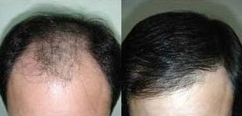 杭州昕薇整形毛发移植术整形案例
