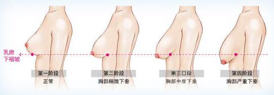 泉州晋江青阳东方整形乳房下垂矫正手术