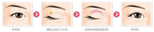 郑州元素双眼皮手术
