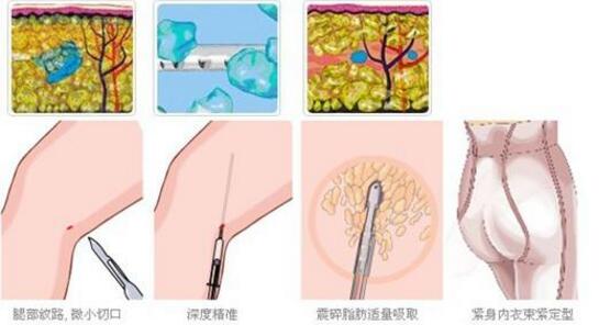 台州广济吸脂手术过程