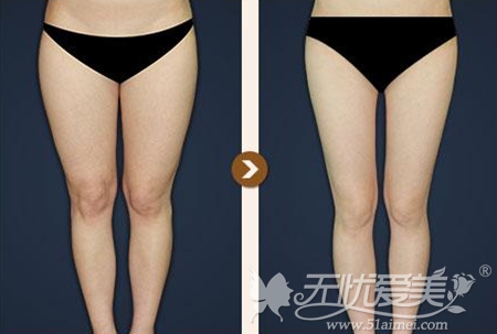 韩国贝缇莱茵大腿吸脂案例