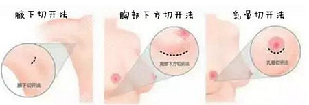 韩国JELIM假体隆胸的三个切开位置
