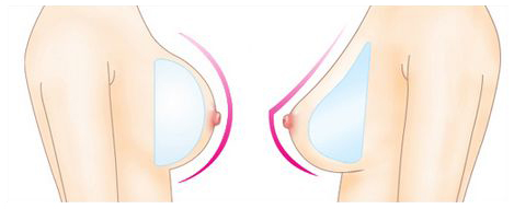 韩国JELIM假体隆胸的两种形态