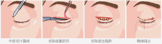 广州爱来双眼皮手术