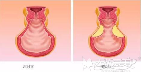 私密部位玻尿酸填充图