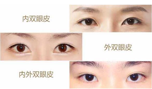郑州望京分析双眼皮的形态