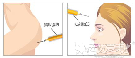 自体脂肪注射丰额头