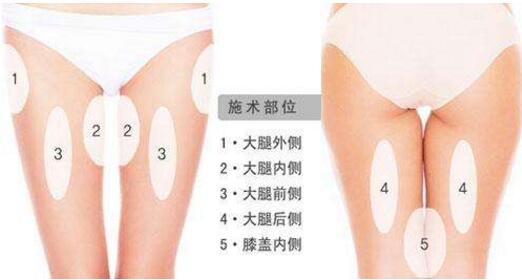 惠州伊美整形腿部吸脂的部位有哪些？
