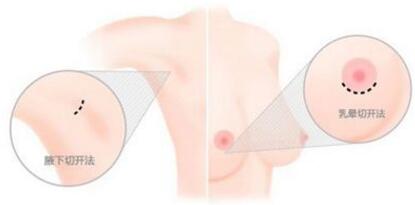 惠州伊美假体隆胸手术 塑造女性性感曲线