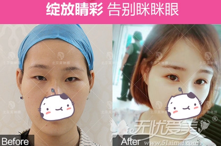 北京莫琳娜自体脂肪填充+全切双眼皮手术案例