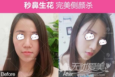 北京莫琳娜隆鼻手术案例