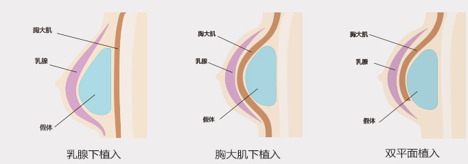 韩国WIZ&美假体隆胸手术切口