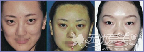 许昌博爱韩式双眼皮手术怎么样？有案例吗？