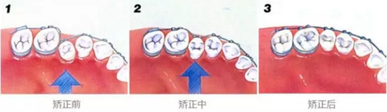韩国oaks矫正牙齿手术过程