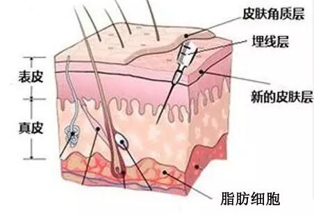 韩国美尔韩面部埋线提升手术