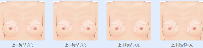 北京联合丽格自体脂肪丰胸手术过程可以改善的部位