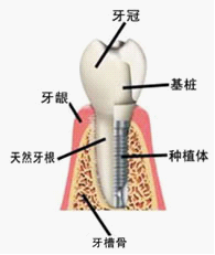 惠州致美口腔医院种植牙