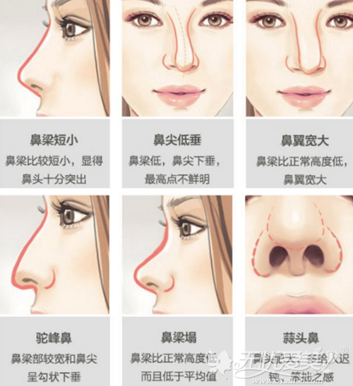 成都华美鼻综合手术可以改善鼻型