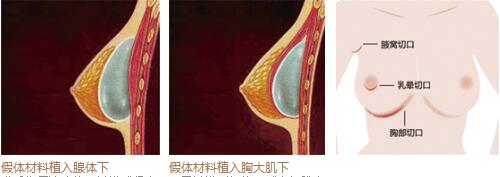 深圳和协假体隆胸手术过程