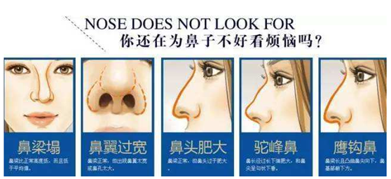 广州嘉悦达拉斯隆鼻手术可以改善鼻型