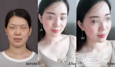 上海华美王荣锡医生面部自体脂肪移植案例