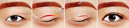 广州美贝尔针对肿泡脂肪型眼睛的双眼皮手术