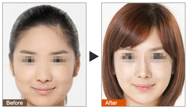 广州美贝尔改脸型手术案例