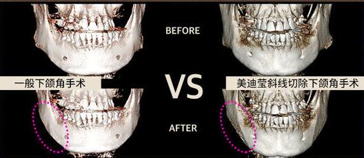 韩国美迪莹下颌角整形手术过程