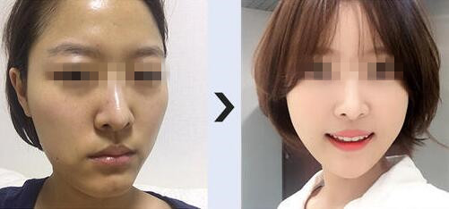 韩国美迪莹下颌角整形手术案例