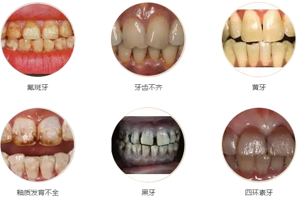 广州医科大口腔医院分析需要牙齿贴面的情况