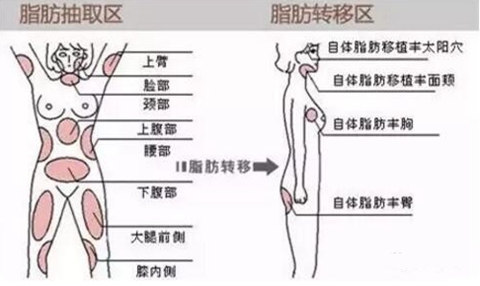 广州雅度自体脂肪移植部位