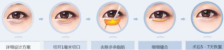 北京澳玛星光精细外切祛眼袋术