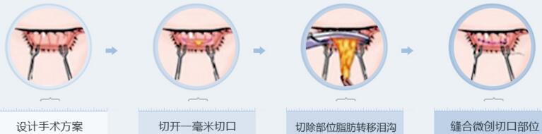 北京澳玛星光眶隔脂肪移位法祛眼袋
